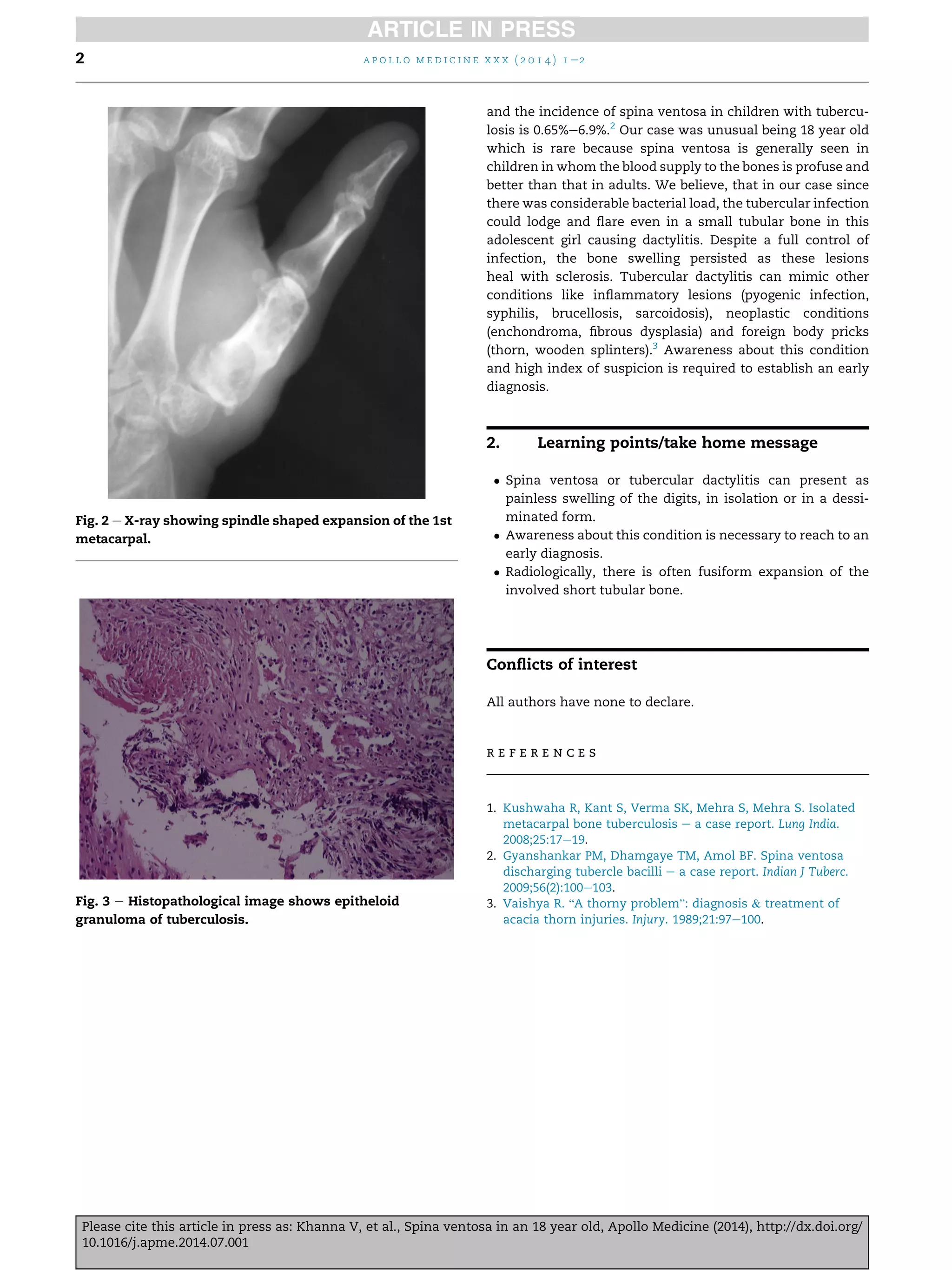 Spina Ventosa of the Second Metacarpal in a Child Without Pulmonary TB: A Case Report - News Directory 3