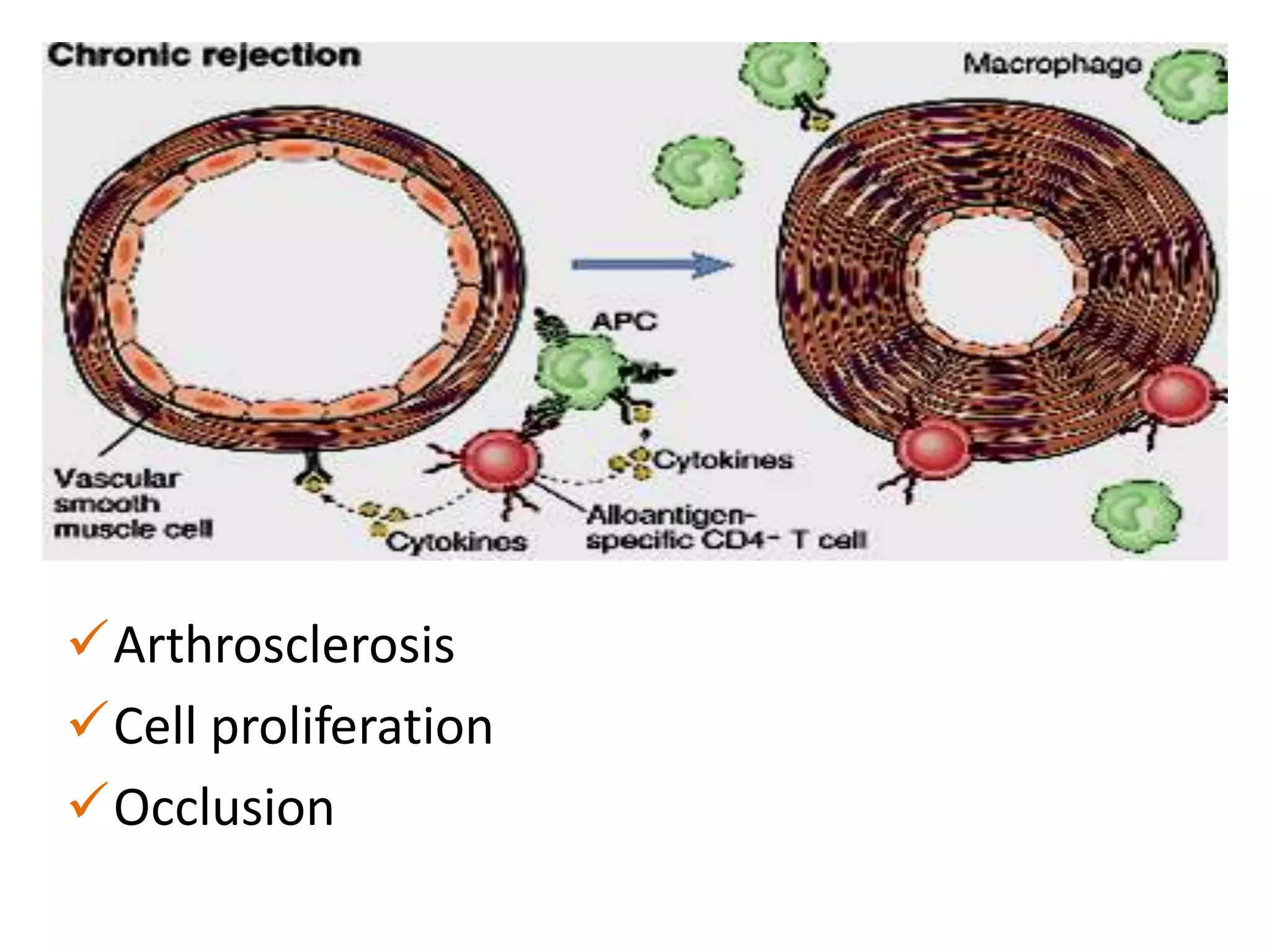 Arthrosclerosis
Cell proliferation
Occlusion

 