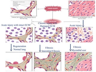 Fibrosis 
Interstitial Fibrosis 
Regeneration 
Normal lung 
Fibrosis 
Mycordial scar 
Acute injury with intact ECM 
Chronic injury with 
Damaged ECM Acute injury 
 