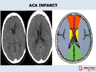 all about stroke imaging in detail final.pptx