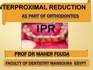 NTERPROXIMAL REDUCTION
PROF DR MAHER FOUDA
FACULTY OF DENTISTRY MANSOURA EGYPT
AS PART OF ORTHODONTICS
 