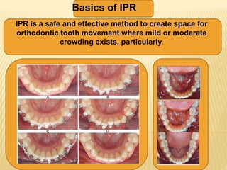 interproximal reduction of enamel as part of orthodontics | PPTX