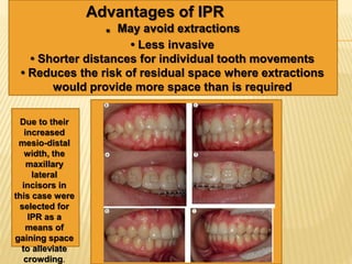 interproximal reduction of enamel as part of orthodontics | PPTX