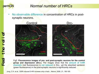 Normal number of HRCs No observable difference  in concentration of HRCs in post-synaptic neurons. Jung, C.H. et al., SSRI induced 5-HR increase only a hack ,  Nature , 2006, 21, 180-185 Fig2.  Flourescence images of pre -  and post - synap tic neurons  for the control group and depression (Drc-).  The images show that the  amount of 5-HR channels  (red fluorescence) is  not reduced  in Drc-, yet the absorbed serotonin (green fluorescence) in the post-synap tic neurons  is significantly reduced. Control  Drc- 