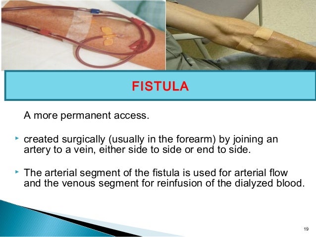 Dialysis Fistula Types