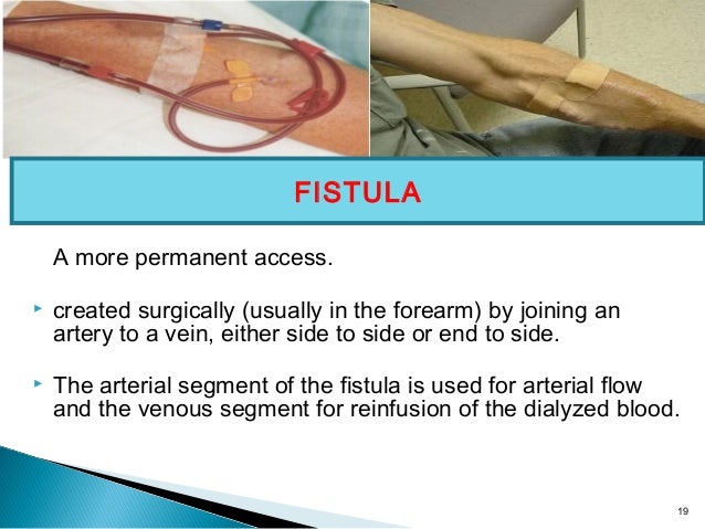 Dialysis dialysis