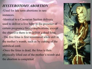 HYSTEROTOMY ABORTION
-Used for late term abortions in rare
instances.
-Identical to a Caesarian Section delivery
used to deliver a live baby in the presence of
certain pregnancy/fetal complications, except
the objective there is to deliver a dead fetus.
-The live fetus is first terminated while still in
the mother‘s womb, such as by cutting of the
umbilical cord.
-Once the fetus is dead, the fetus is then
physically lifted out of the mother‘s womb and
the abortion is completed.
 