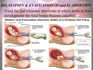 DILATATION & EVACUATION (D and E) ABORTION
 -Used for 2nd trimester abortions, at which point in fetal
 development the fetal bones become calcified.
 