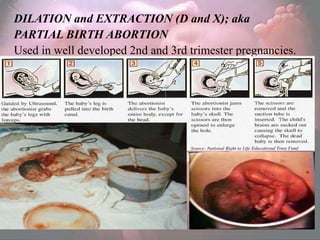 DILATION and EXTRACTION (D and X); aka
PARTIAL BIRTH ABORTION
Used in well developed 2nd and 3rd trimester pregnancies.
 
