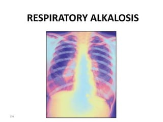 104
RESPIRATORY ALKALOSIS
 