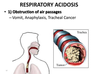 97
RESPIRATORY ACIDOSIS
• 1) Obstruction of air passages
–Vomit, Anaphylaxis, Tracheal Cancer
 