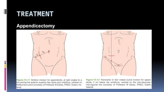 TREATMENT
Appendicectomy
 