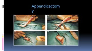 Appendicectom
y
 