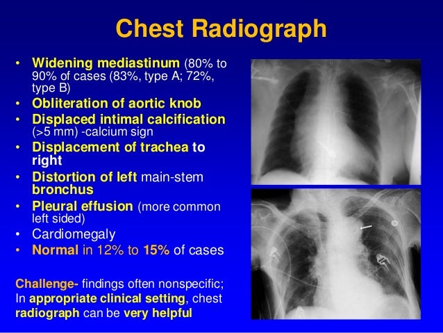 Final acute aortic syndrome = dr sanjiv