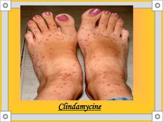 Adverse drug reaction | PPT