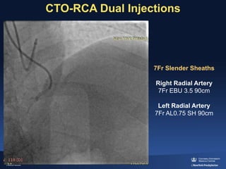 Cto Dual Injection Debate: Is there a difference between RDR and reverse CART? – No | PPTX