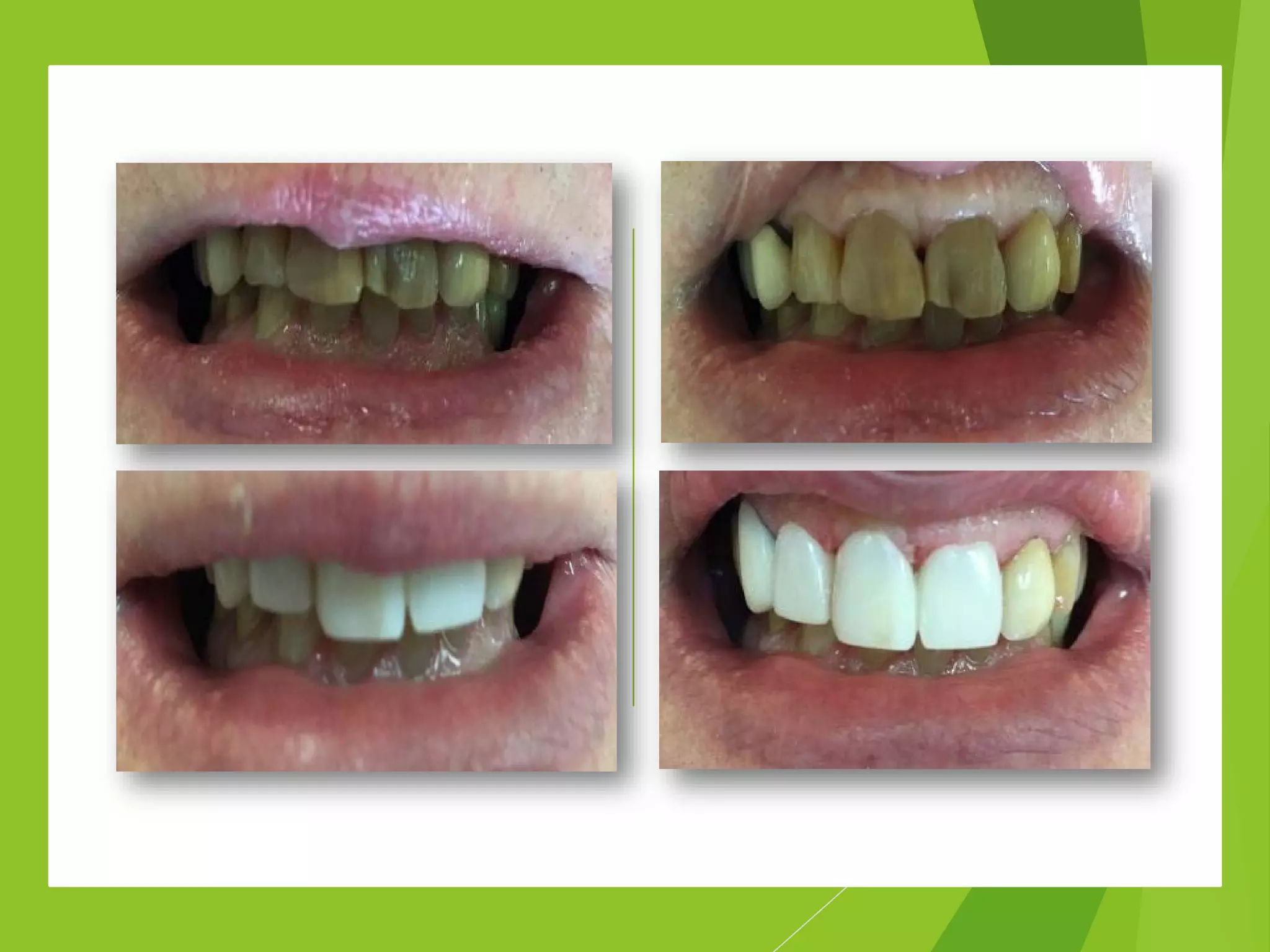 Aesthetic Anterior Composite - A Simple Technique | PDF