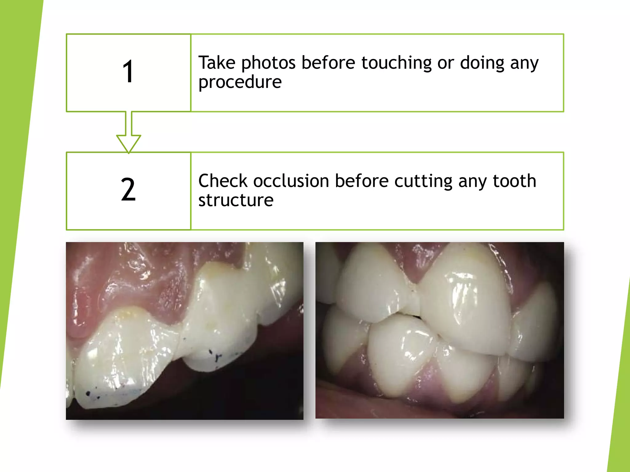 Aesthetic Anterior Composite - A Simple Technique | PDF