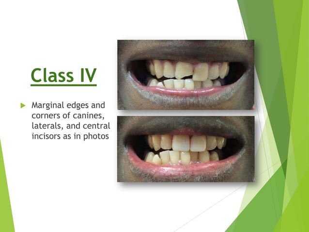 Aesthetic Anterior Composite - A Simple Technique | PDF