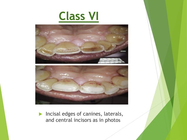 Aesthetic Anterior Composite - A Simple Technique | PDF