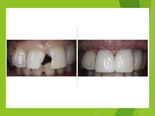 Aesthetic Anterior Composite - A Simple Technique | PDF