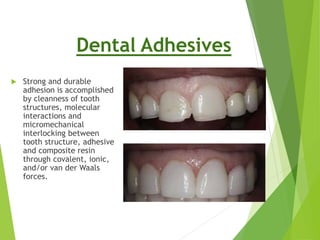 Aesthetic Anterior Composite - A Simple Technique | PDF