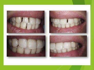Aesthetic Anterior Composite - A Simple Technique | PDF