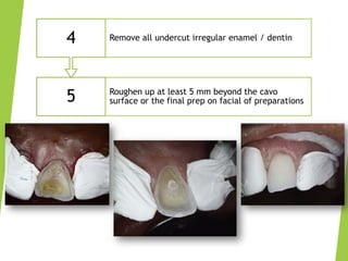Aesthetic Anterior Composite - A Simple Technique | PDF