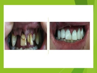 Aesthetic Anterior Composite - A Simple Technique | PDF