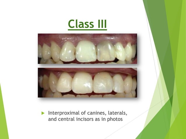 Aesthetic Anterior Composite - A Simple Technique | PDF