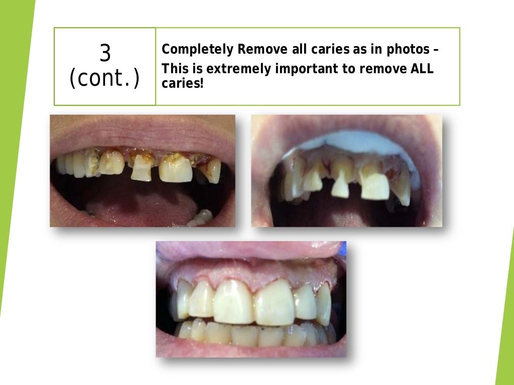 Aesthetic Anterior Composite A Simple Technique