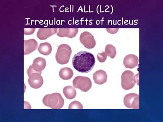 T Cell ALL (L2)
Irregular clefts of nucleus
 