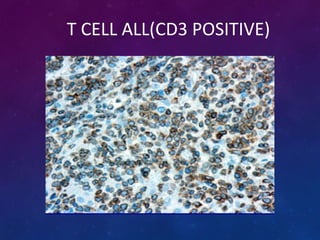 T CELL ALL(CD3 POSITIVE)
 