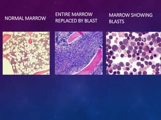 NORMAL MARROW
ENTIRE MARROW
REPLACED BY BLAST
MARROW SHOWING
BLASTS
 