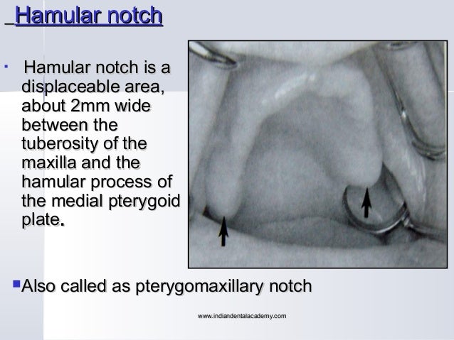 hamular notch