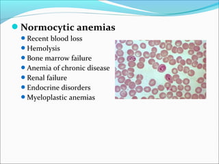 Normocytic anemias
Recent blood loss
Hemolysis
Bone marrow failure
Anemia of chronic disease
Renal failure
Endocrine disorders
Myeloplastic anemias
 