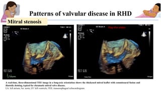 Patterns of valvular disease in RHD
A real-time, three-dimensional TEE image in a long-axis orientation shows the thickene...