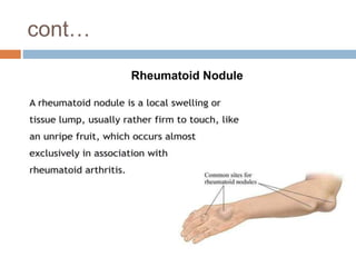 cont…
Rheumatoid Nodule
 