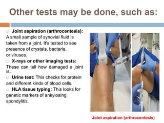 Other tests may be done, such as:
 Joint aspiration (arthrocentesis):
A small sample of synovial fluid is
taken from a joint. It's tested to see
presence of crystals, bacteria,
or viruses.
 X-rays or other imaging tests:
These can tell how damaged a joint
is.
 Urine test: This checks for protein
and different kinds of blood cells.
 HLA tissue typing: This looks for
genetic markers of ankylosing
spondylitis.
Joint aspiration (arthrocentesis)
 