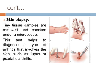 cont…
 Skin biopsy:
Tiny tissue samples are
removed and checked
under a microscope.
This test helps to
diagnose a type of
arthritis that involves the
skin, such as lupus or
psoriatic arthritis.
 