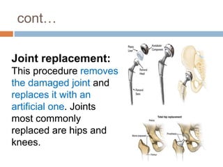 cont…
Joint replacement:
This procedure removes
the damaged joint and
replaces it with an
artificial one. Joints
most commonly
replaced are hips and
knees.
 
