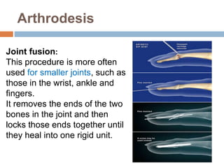 Arthrodesis
Joint fusion:
This procedure is more often
used for smaller joints, such as
those in the wrist, ankle and
fingers.
It removes the ends of the two
bones in the joint and then
locks those ends together until
they heal into one rigid unit.
 