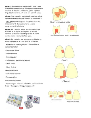 Clase 1: Cavidades que se preparan para tratar caries
que se localizan en las fosas, surcos y fisuras de las caras
oclusales de molares y premolares, y en la superficie
lingual de los incisivos, solo basta con retirar la caries.
Clase 2: Estas cavidades además de la superficie oclusal
incluyen una pared proximal o las dos en los molares y
Clase 3: Son cavidades que se encuentran en el área
interproximal de dientes anteriores, pero no
comprometen ángulo incisal
Clase 4: Son cavidades hechas retirando caries o por
fracturas en un ángulo incisal ya sea de incisivos
centrales o laterales, haciendo gradiente de resina
dentin, enamel y otorgando halo opaco.
Clase 5: Son cavidades que se encuentran ubicadas en
el tercio gingival de las caras libres de los dientes.
Para hacer un buen diagnóstico o tratamiento es
necesario analizar:
-El estado del diente
-Si es restaurable
-El estado pulpar
-Profundidad o severidad de la lesión
-Estado pulpar
-Estado dentinal
-Soporte del diente
-Evaluar color a aplicar
-Técnica a aplicar
Instrumental completo
-materiales para acabado y pulido final adecuados como
fresas y discos para pulir o puntas para pulir
 