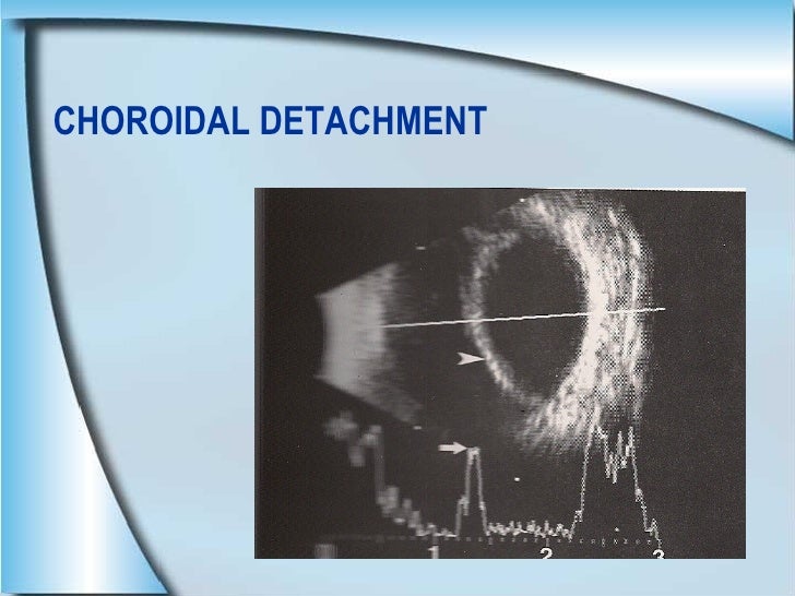 CHOROIDAL DETACHMENT KISSING CHOROIDS 58 CHOROIDAL DETACHMENT KISSING CHOROIDS 58