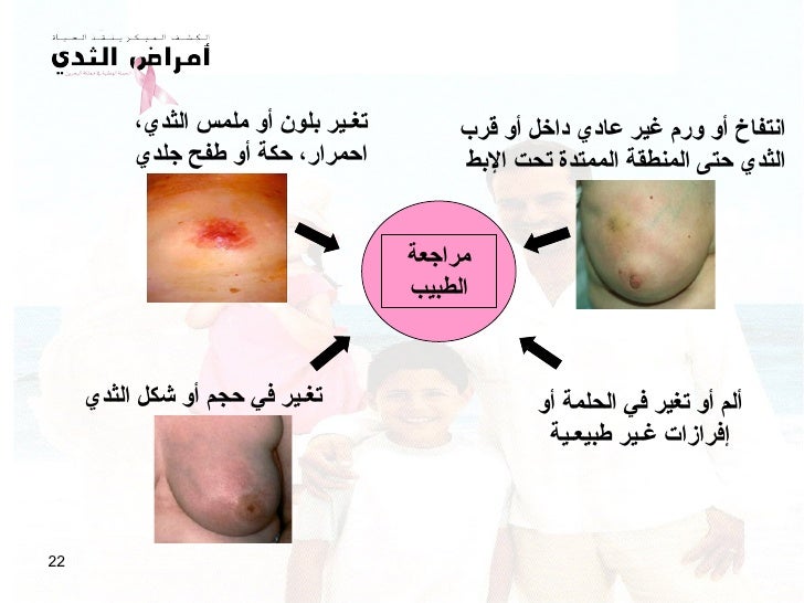 بعناية افعل كل شيء بقوتي تتعدد طفح جلدي على الثدي Mpkidneyfoundation Com