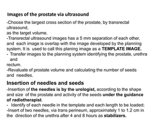 Images of the prostate via ultrasound
-Choose the largest cross section of the prostate, by transrectal
ultrasound,
as the target volume.
-Transrectal ultrasound images has a 5 mm separation of each other,
and each image is overlap with the image developed by the planning
system. It is used to call this planing image as a TEMPLATE IMAGE.
- Transfer images to the planning system identifying the prostate, urethra
and
rectum.
-Revaluate of prostate volume and calculating the number of seeds
and needles.
Insertion of needles and seeds
-Insertion of the needles is by the urologist, according to the shape
and size of the prostate and activity of the seeds under the guidance
of radiotherapist.
- Identify of each needle in the template and each length to be loaded;
-Insert of two needles, via trans perineum, approximately 1 to 1.2 cm in
the direction of the urethra after 4 and 8 hours as stabilizers.
 