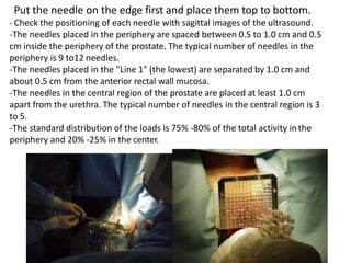Put the needle on the edge first and place them top to bottom.
- Check the positioning of each needle with sagittal images of the ultrasound.
-The needles placed in the periphery are spaced between 0.5 to 1.0 cm and 0.5
cm inside the periphery of the prostate. The typical number of needles in the
periphery is 9 to12 needles.
-The needles placed in the "Line 1" (the lowest) are separated by 1.0 cm and
about 0.5 cm from the anterior rectal wall mucosa.
-The needles in the central region of the prostate are placed at least 1.0 cm
apart from the urethra. The typical number of needles in the central region is 3
to 5.
-The standard distribution of the loads is 75% -80% of the total activity inthe
periphery and 20% -25% in the center.
 