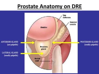 Prostate Anatomy on DRE
 