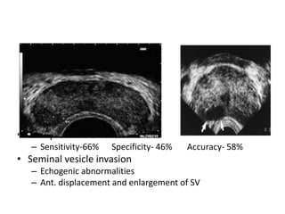 • Extraprostatic extension
– Sensitivity-66% Specificity- 46% Accuracy- 58%
• Seminal vesicle invasion
– Echogenic abnormalities
– Ant. displacement and enlargement of SV
 