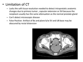 • Limitation of CT
– Lacks the soft tissue resolution needed to detect intraprotatic anatomic
changes due to primary tumor , capsular extension or SVI because the
neoplasm usually has the same attenuation as the normal prostate gland
– Can't detect microscopic disease
– False Positive- Artifact of Bx and plane b/w SV and UB base may be
obscured by rectal distension
 
